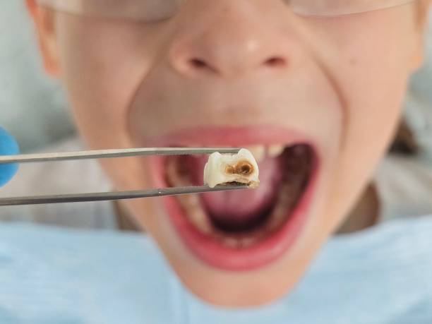 Best Emergency Dental Extractions in Osgood, IN